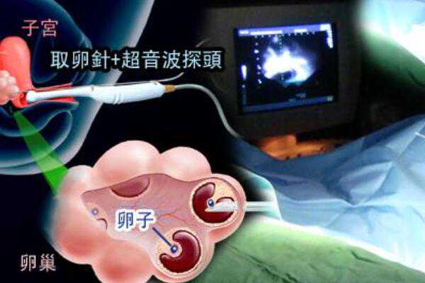 广州代孕医院有几家,2023广州哪家可以供卵试管生子？附广州正规供卵试管医院